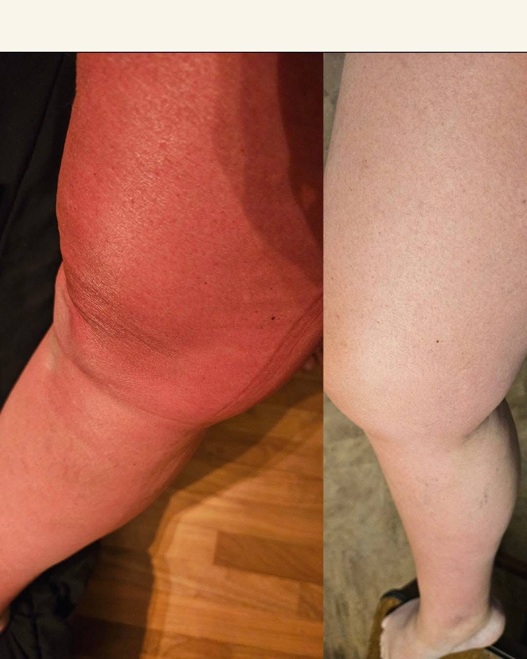 ✨It’s Testimonial Tuesday✨￼

We had an amazing time at Team Retreat this past weekend. My friend Candace enjoyed the sunshine and got a little burnt!

Here is her story on how she managed her sunburn.

￼”At team retreat I got a SUNBURN, I don't often lay in the sun but decided to soak up all the vitamin D I could.  You know how it goes, you don't see or feel the burn until later. Everyone else looked at me and thought I was the lobster 🦞. 

It was a great time to put the Gelee to the test! 

I was amazed!!!! It took both the heat and redness out the burn with the first application, and with the second application my burn returned to more of a normal tan.  Even though I have a few on order already.. I am adding more for friends and family.  Plus the bonus is it took care of the mosquito bites from around the campfire too. 

Check out the before and after photos 24 hours, 2 applications.. 

I am definitely ordering more!”

We have a BOGO right now with 50 percent off your second tube, don’t miss this!